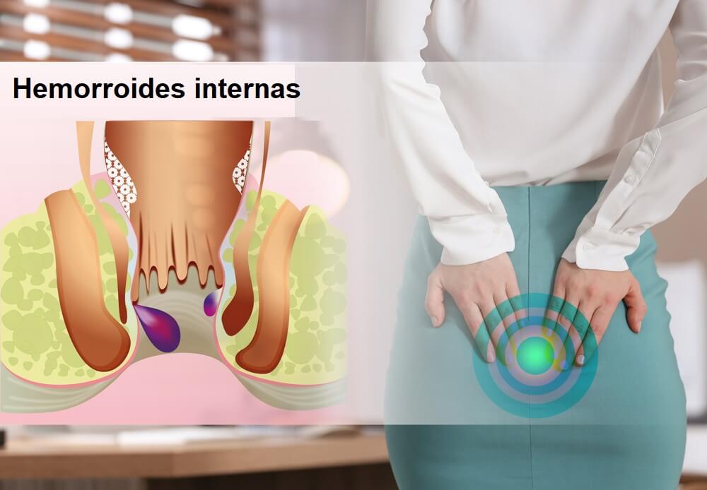 MUJER-CON-DOLOR-EN-EL-TRASERO-JUNTO-A-ESQUEMA-DE-HEMORROIDES-INTERNAS-TIPOS-DE-HEMORROIDES